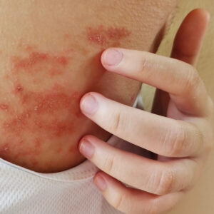 Eczema