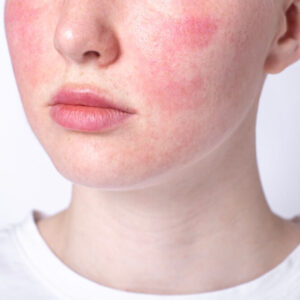 Rosacea