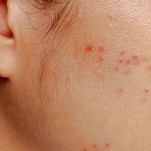 Acne