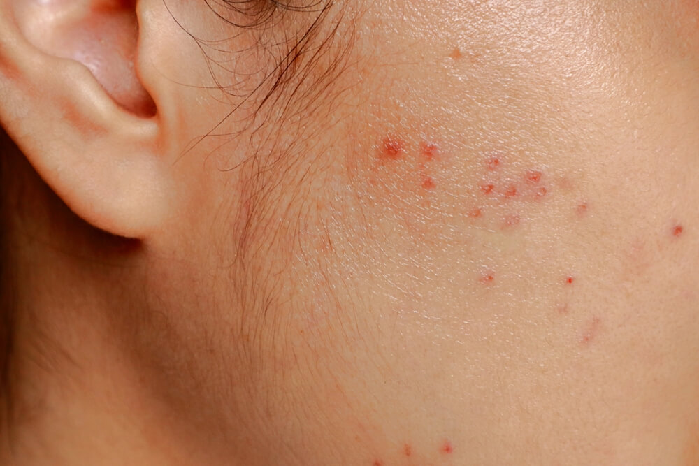 Acne