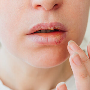 Cold Sore