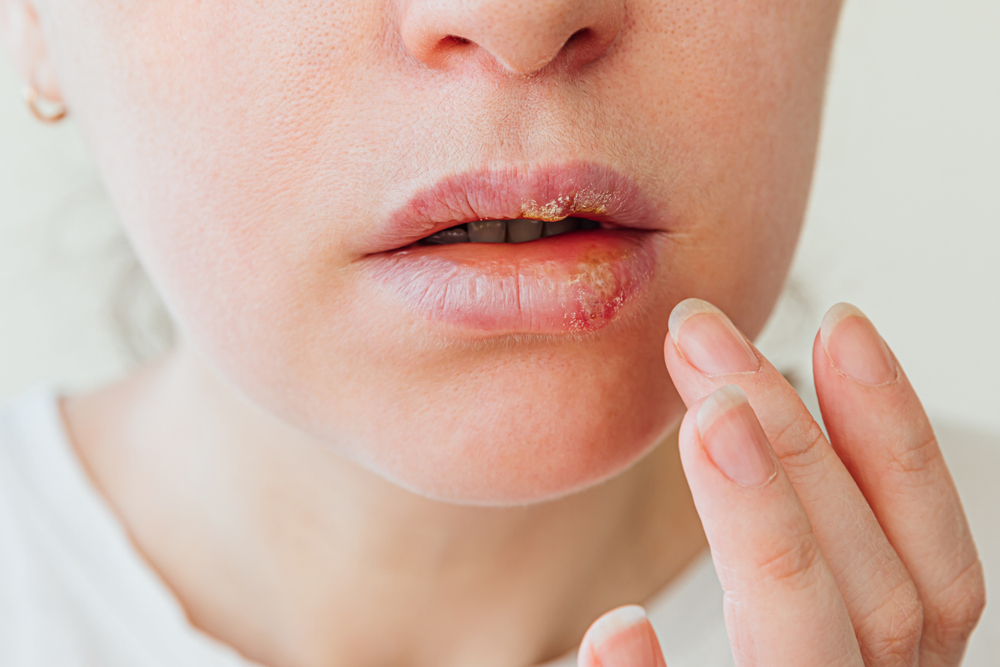 Cold Sore