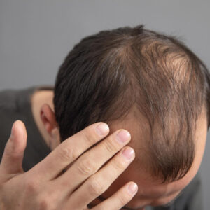 Hair Loss