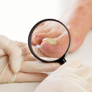 Nail Infections