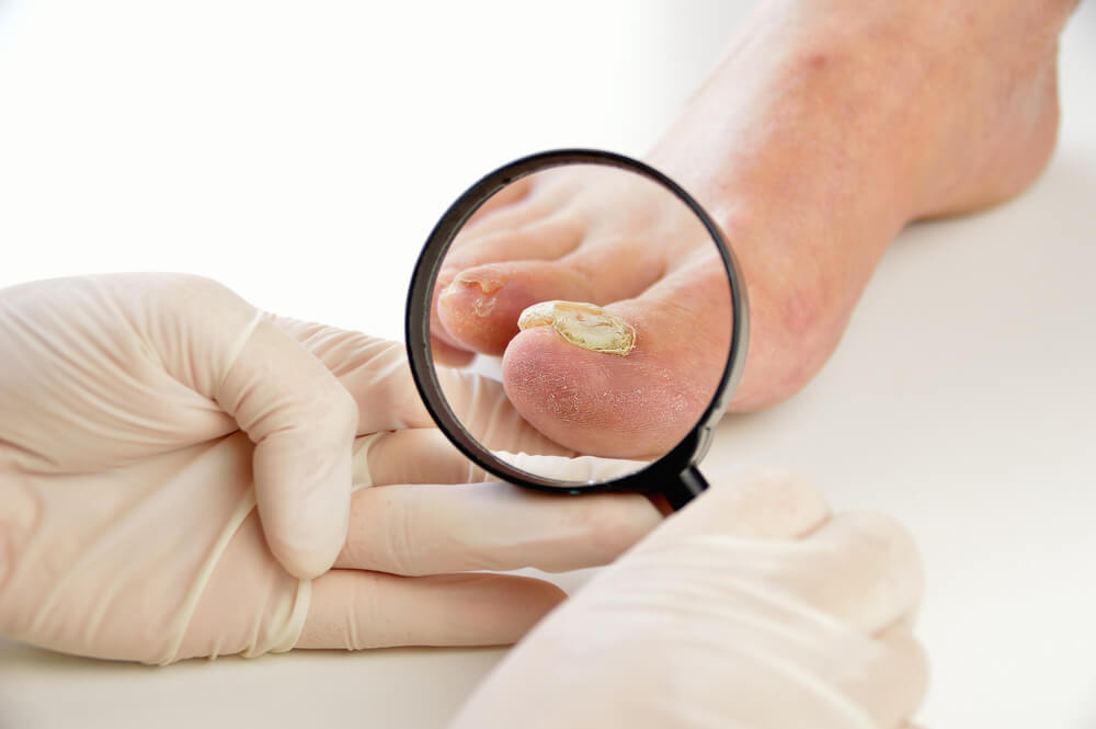 Nail Infections