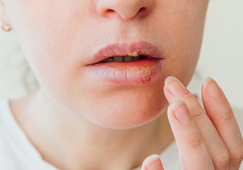 Cold Sores Treatment